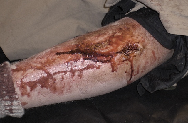 leg wound