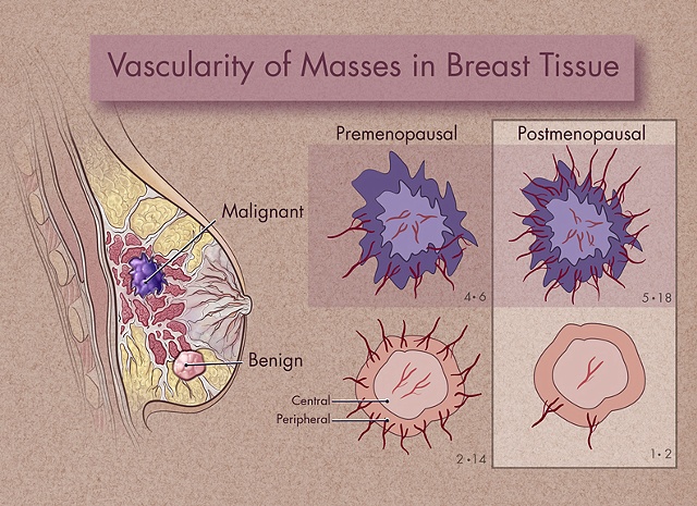 Breast Cancer Architecture