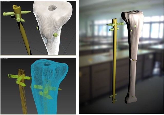 3D Tibial Screw Insertion with External Fixation Device