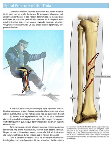 Spiral Fracture of the Tibia