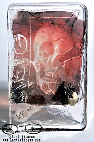 photo emulsion suspended in resin with real human tooth with broken filling 