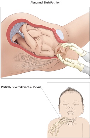 medical legal birth injury, mock case for brachial plexus injury