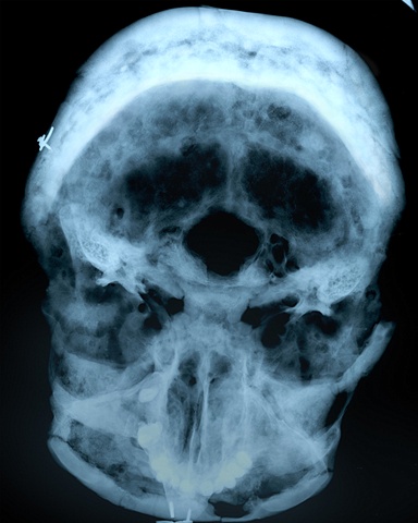 CMNH, department of physical anthropology, pagets disease, xray