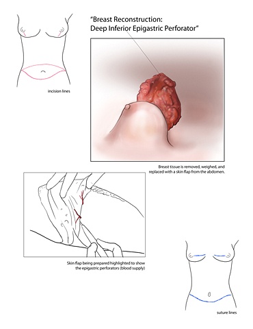 surgical illustration, mastectomy with TRAM