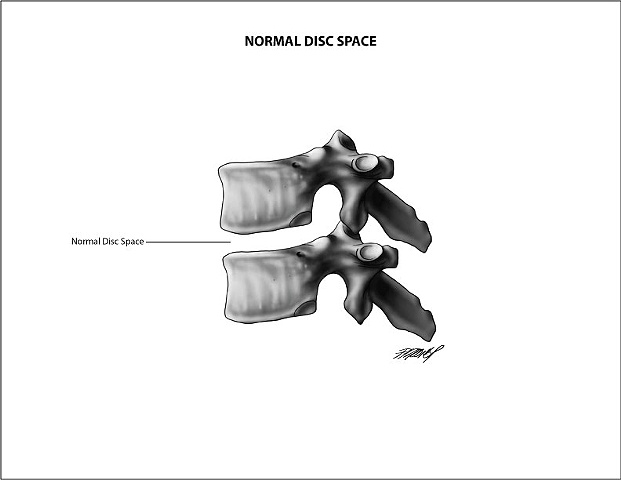 Normal Vertebral Disc 
