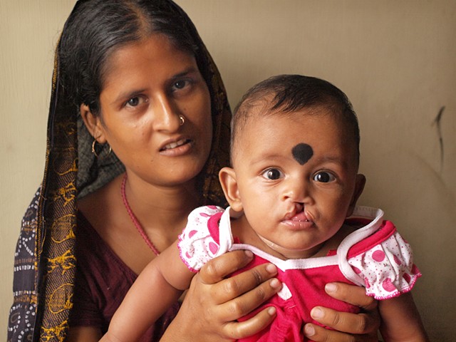 Mother with child who has cleft lip