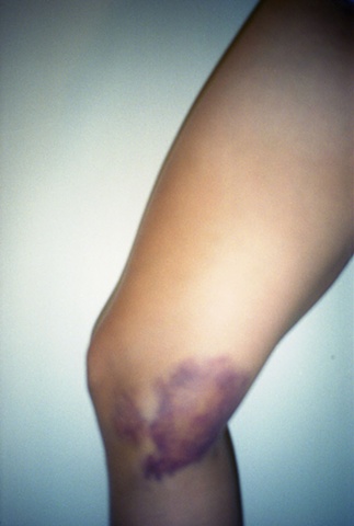 color photograph of bruise by iris grimm