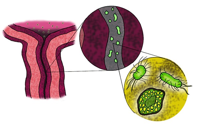 Urinary Infection Illustration