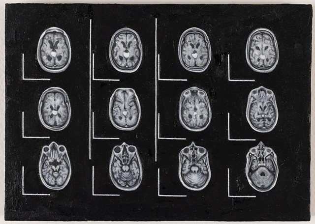 MRI (2006) - Pineal Germinoma 