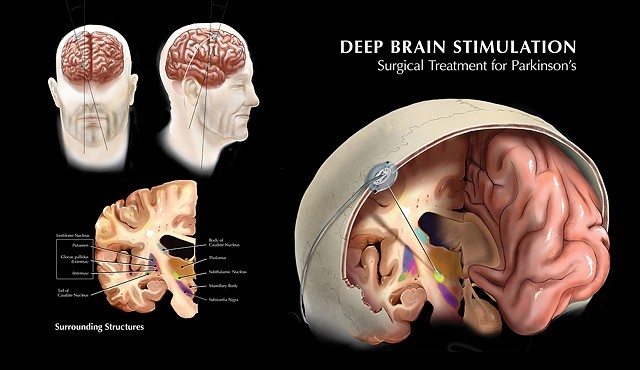 Deep Brain Stimulation by Karlee D. Rogers