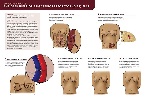 The Deep Inferior Epigastric Perforator Flap Surgery by Jennifer McCabe