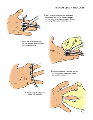 Ring Removal Method