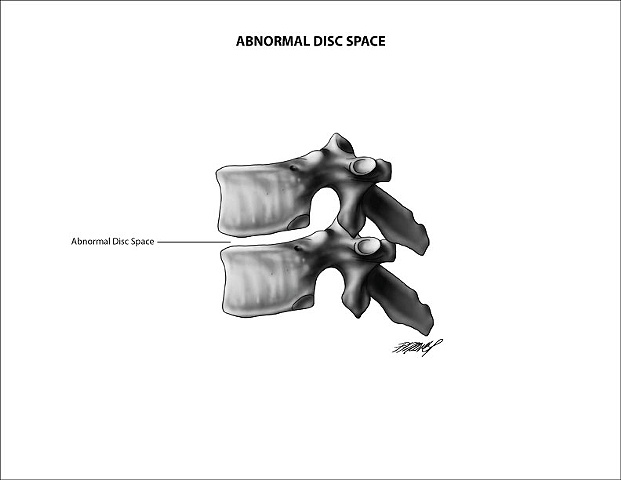 Abnormal Vertebral Disc 
