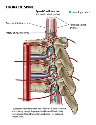 Thoracic Spine: Spinal Cord Infarction
