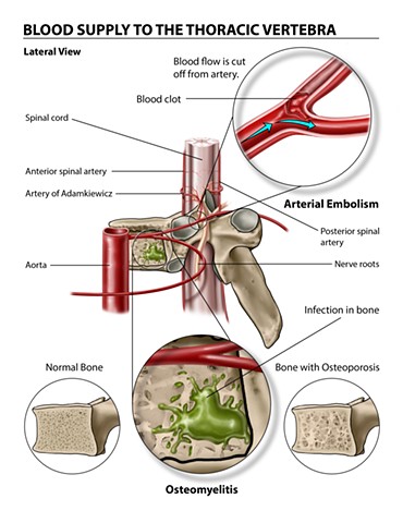 Blood Supply to the Thoracic Vertebra: Osteomyelitis