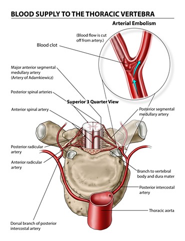 Blood Supply to the Thoracic Vertebra: Arterial Embolism