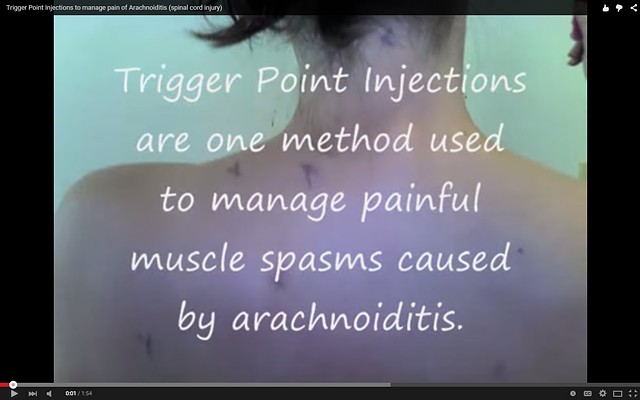 Trigger Point Injections 