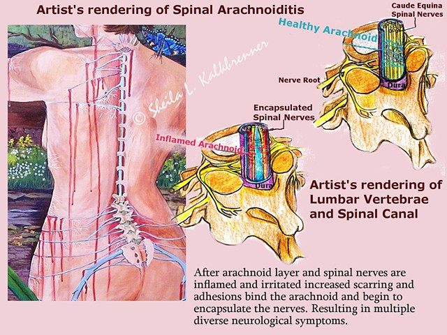 art for arachnoiditis, art and healing, Dr.Burton, Dr.Forest Tennant, back pain, arachnoiditis, Wellness Art, 