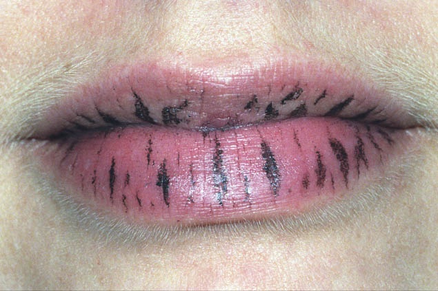 Anika Smulovitz Lips Untitled stripes