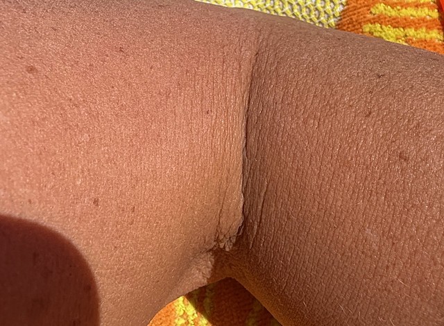 Bent Arm