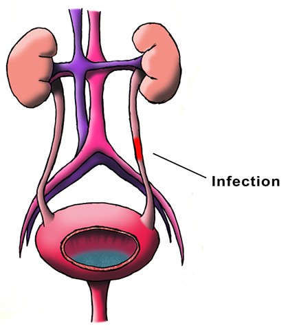 Urinary Tract Infection Illustration