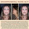 Disappearing Nose Act