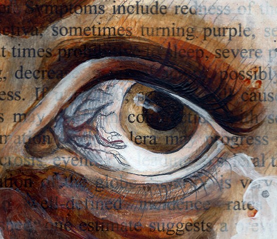 medical illustration, paint, painting, fine art, drawing, text, medical text, medical literature, eye, eyes, eyeball, eyeballs, anatomy, anatomical, scientific, medical, grotesque, disturbing, nasty, morbid, morbidity, disease, medical condition, eye cond