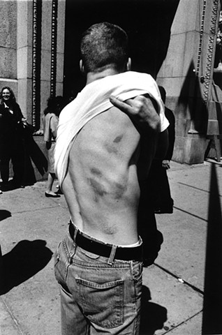 ACT UP/Chicago protester with injuries inflicted by Chicago police, AMA demonstration, Chicago, June 1991 June 1991. Photograph Linda Miller
