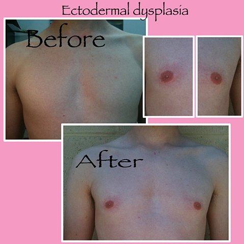 Ectodermal Dysplasia June 2011