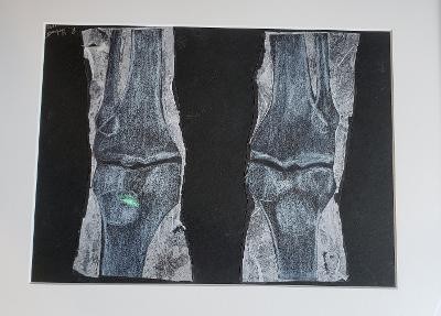 Collage in black and white of knee bones.