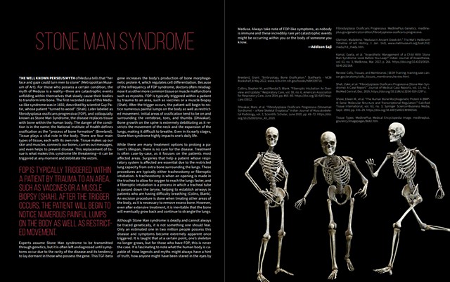 Stone Man Syndrome