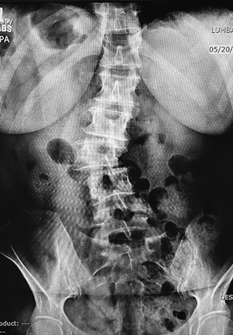 Lower lumbar crumple (surprise scoliosis too!)