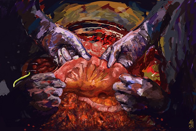 Exploratory Laparotomy