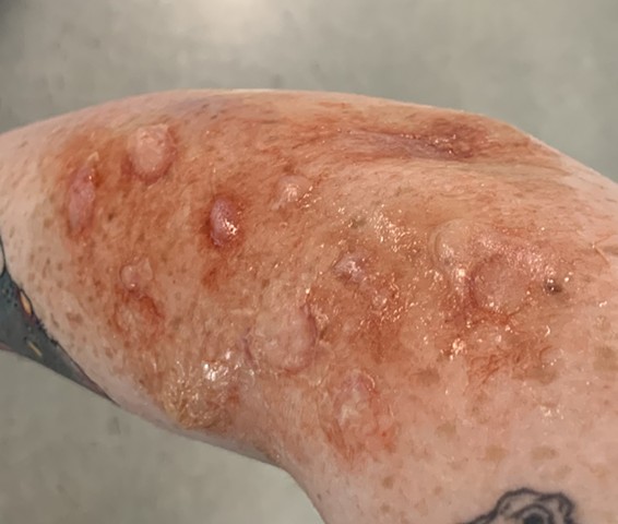 2nd Degree Burn