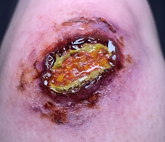 Zombie Wound 