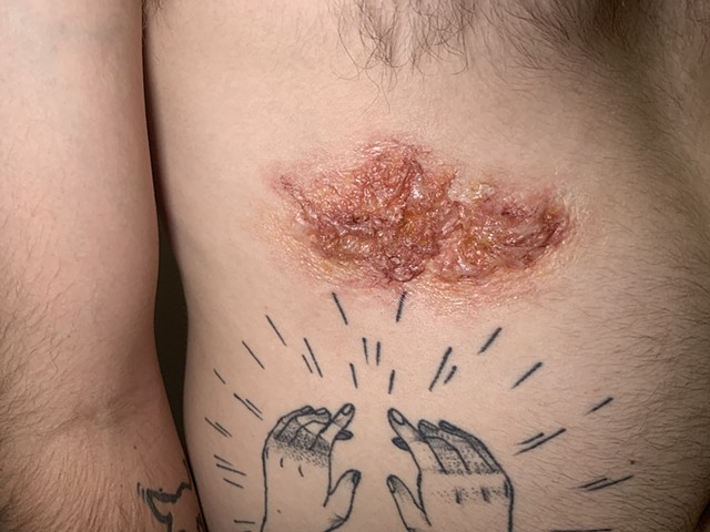 Infected Wound 
